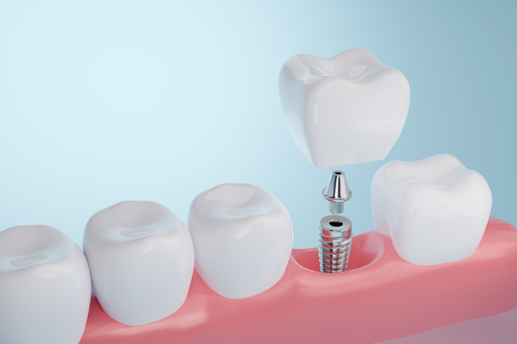 Featured image for How Do Dental Implants Work