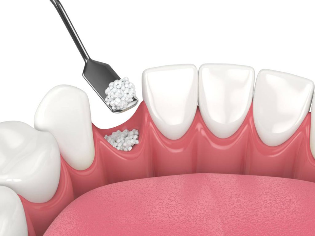 Preparing For Dental Implants With Bone Grafting - Valley Alder Blog