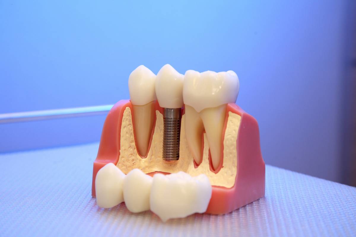 Featured image for What Is Prosthodontics